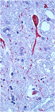 Brain tissue from a West Nile encephalitis patient, showing antigen-positive neurons and neuronal processes (in red).