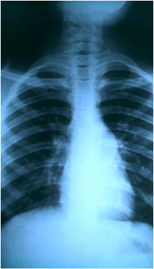 X-ray photo of the lungs of a patient with tuberculosis.